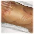 HYDROCOLL - Pansament hidrocoloidal