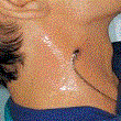 HYDROFILM - Plasture steril transparent, autoadeziv